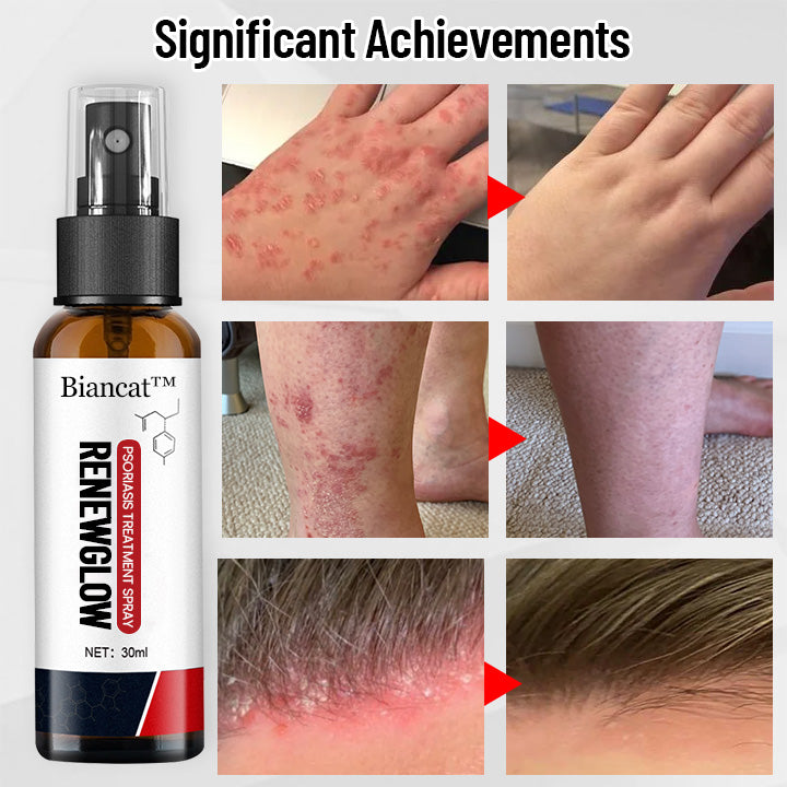 Biancat™ RenewGlow Psoriasis Treatment Spray