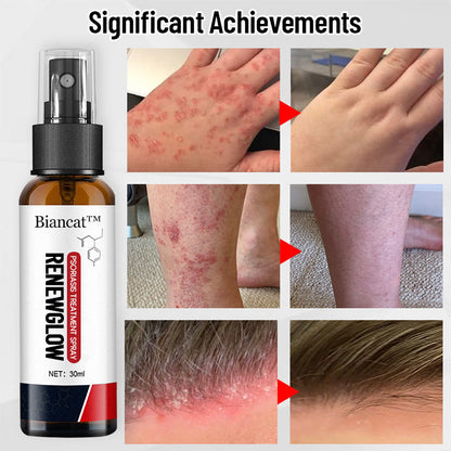 Biancat™ RenewGlow Psoriasis Treatment Spray