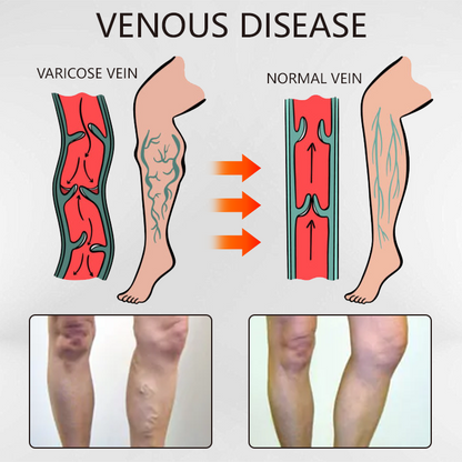 Ceoerty™ Varicose Veins Relief Oil