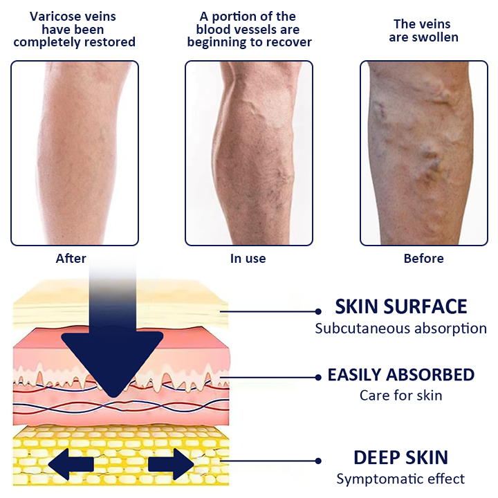 Ceoerty™ VeinEase Mucopolysaccharide Polysulfate Cream